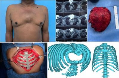 使用 3D 打印的定制钛植入物进行整个胸骨肋骨重建