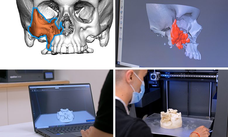 一家儿童医院，在3D打印技术的帮助下成功切除眼部肿瘤