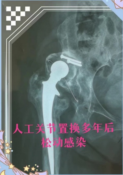 ҽԺǿӦ3DӡΪСԺ֢ؽŹؽڹ