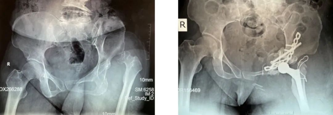 使用3D打印多孔钽金属假体对严重骨盆缺损患者进行髋关节翻修重建手术