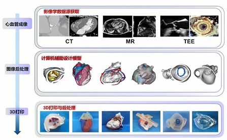 杨剑教授：心血管3D打印技术在结构性心脏病介入治疗中的应用