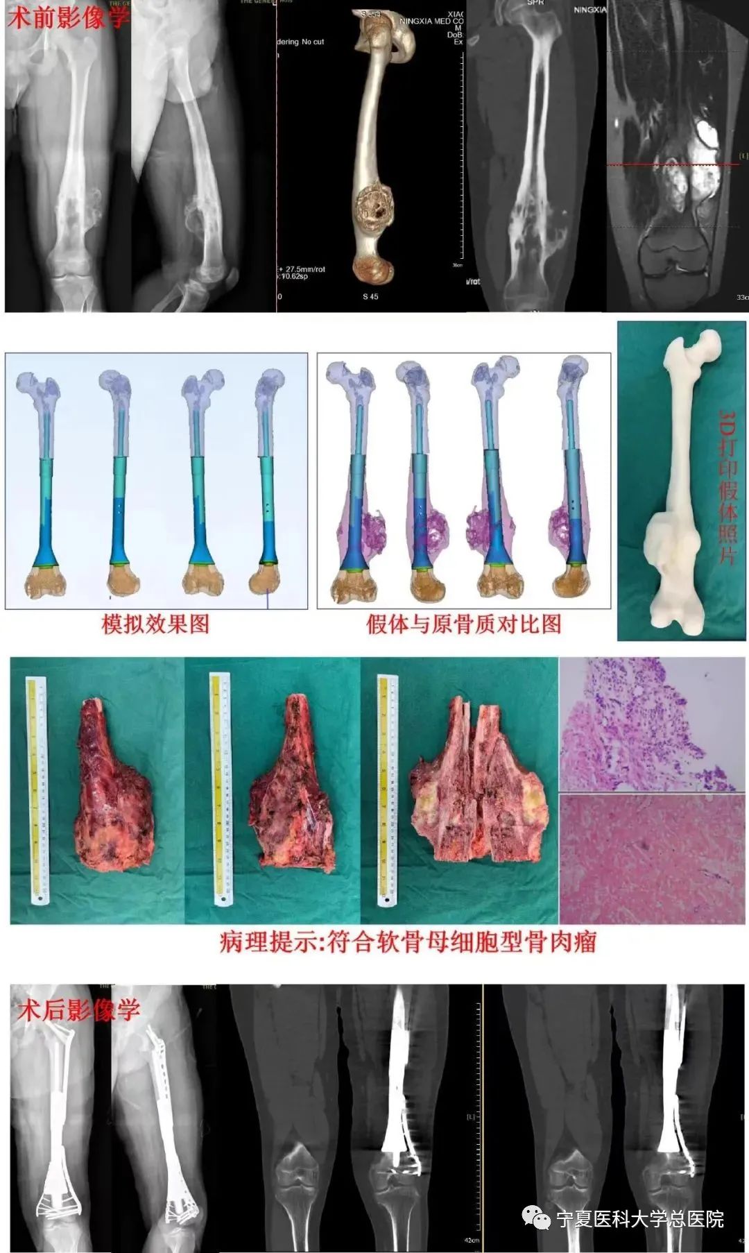 一文读懂软组织肉瘤的分类、家族遗传、患病风险、症状和体征 - 知乎