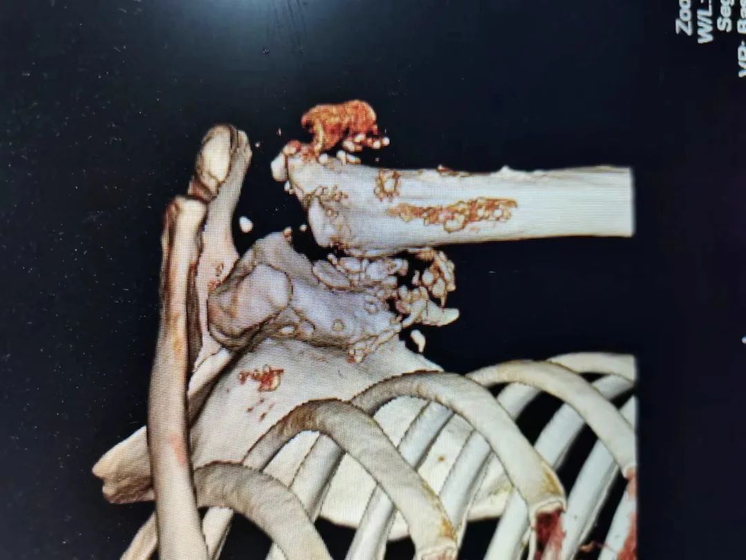 3D打印定制肘关节假体置换、反置式肩关节置换治疗罕见病―夏科氏关节病