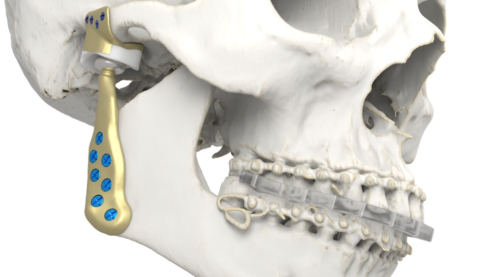 Materialise推出完整的全颞下颌关节（TMJ）植入物数字化工作流程