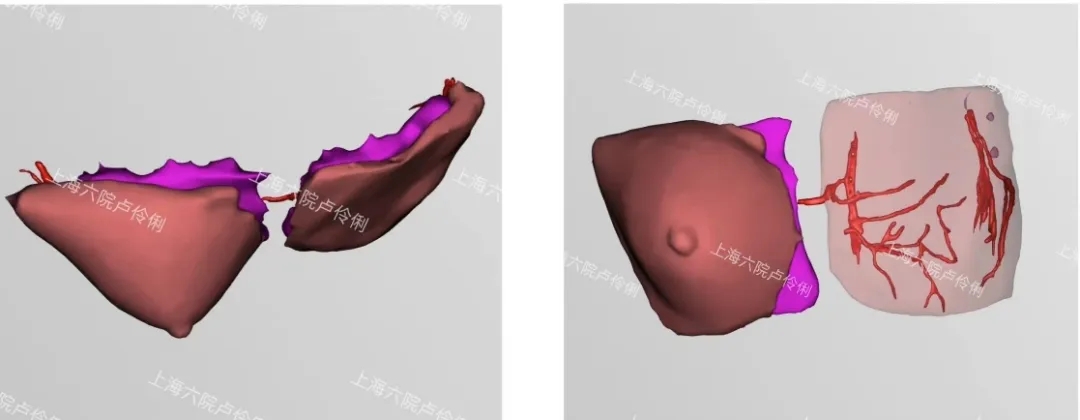 ϺеҽԺ3Dӡ1:1鷿Ϊٰ